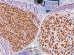 Learn what CD56 IHC positivity means in neuroendocrine tumors and NK-cell neoplasms, including staining patterns, marker panels, diagnostic pitfalls, and next steps.