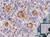 CD15 IHC Test: Hodgkin Lymphoma Marker, Positive Staining, and Tumor Classification Learn how CD15 IHC is used in classic Hodgkin lymphoma, what positive and negative staining mean, and how CD30, PAX5, CD20, and other markers guide classification.