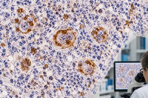 CD15 IHC Test: Hodgkin Lymphoma Marker, Positive Staining, and Tumor Classification Learn how CD15 IHC is used in classic Hodgkin lymphoma, what positive and negative staining mean, and how CD30, PAX5, CD20, and other markers guide classification.