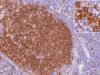 CD20 IHC Test: B-Cell Lymphoma Marker, B-Cell Lineage, and Positive Staining Learn what CD20-positive IHC staining means, how it supports B-cell lymphoma lineage, why some B-cell tumors are CD20 negative, and how CD20 can relate to targeted therapy.