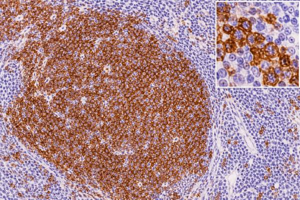 CD20 IHC Test: B-Cell Lymphoma Marker, B-Cell Lineage, and Positive Staining Learn what CD20-positive IHC staining means, how it supports B-cell lymphoma lineage, why some B-cell tumors are CD20 negative, and how CD20 can relate to targeted therapy.