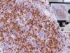 Learn what CD3 IHC positive staining means, how CD3 supports T-cell lineage, and why reactive T cells, antigen loss, and NK/T-cell lymphoma can complicate interpretation.