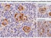 CD30 IHC Test: Hodgkin Lymphoma, T-Cell Lymphoma, and Positive Staining Understand what a CD30 IHC test shows, how positive staining is interpreted in Hodgkin lymphoma and T-cell lymphoma, and why CD30 results require a full pathology panel.