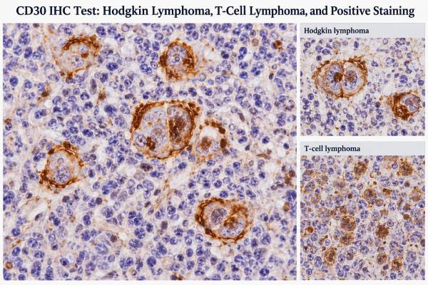 CD30 IHC Test: Hodgkin Lymphoma, T-Cell Lymphoma, and Positive Staining Understand what a CD30 IHC test shows, how positive staining is interpreted in Hodgkin lymphoma and T-cell lymphoma, and why CD30 results require a full pathology panel.