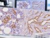CD34 IHC Test: Leukemia, Vascular Tumors, Stem Cell Marker, and Positive Staining Learn what CD34 IHC positivity means in bone marrow, leukemia, vascular tumors, and soft-tissue tumors, including staining patterns, pitfalls, and follow-up tests.