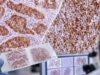 CD45 IHC Test: Leukocyte Common Antigen, Lymphoma Marker, and Tumor Origin Understand CD45 (leukocyte common antigen) IHC, what positive or negative staining means, how it helps identify lymphoma, and why marker panels are essential.