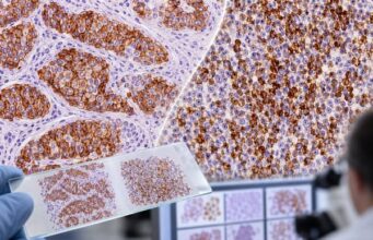 Understand CD45 (leukocyte common antigen) IHC, what positive or negative staining means, how it helps identify lymphoma, and why marker panels are essential.