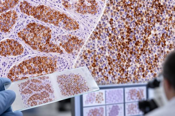 Understand CD45 (leukocyte common antigen) IHC, what positive or negative staining means, how it helps identify lymphoma, and why marker panels are essential.