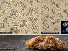 Calcium Oxalate Crystals in Urine: Kidney Stones, Causes, and Meaning Calcium oxalate crystals are common and may occur without stones. Learn their shapes, causes, stone-risk meaning, 24-hour urine follow-up, and warning signs.
