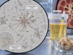 Calcium Phosphate Crystals in Urine: Kidney Stones, Alkaline Urine, and Meaning Calcium phosphate crystals in urine often reflect alkaline urine and may signal kidney stone risk. Learn the causes, pH link, testing, and prevention steps.