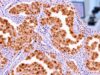 Learn what calretinin IHC positive staining means, how it supports mesothelioma and mesothelial origin, and why BAP1, MTAP, and carcinoma markers are often needed.