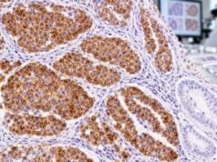 Understand chromogranin IHC positivity in neuroendocrine tumors, including granular staining, tumor differentiation, marker panels, negative results, and diagnostic pitfalls.