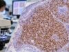 Cyclin D1 IHC Test: Mantle Cell Lymphoma Marker, Positive Staining, and Diagnosis Learn how cyclin D1 IHC supports mantle cell lymphoma diagnosis, what nuclear positivity means, why rare MCL can be negative, and which confirmatory tests are used.