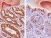 Cytokeratin 20 (CK20) IHC Test: GI Cancer, Bladder Cancer, Tumor Origin, and Staining Pattern Understand CK20 IHC in colorectal, GI, bladder, and metastatic cancer, including CK7/CK20 patterns, positive staining, common pitfalls, and site-of-origin testing.