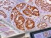 Cytokeratin 7 (CK7) IHC Test: Tumor Origin, Positive Staining Pattern, and Cancer Type Learn what CK7 IHC positivity means, which cancers are often CK7 positive or negative, how CK7/CK20 patterns guide tumor origin, and where pitfalls occur.