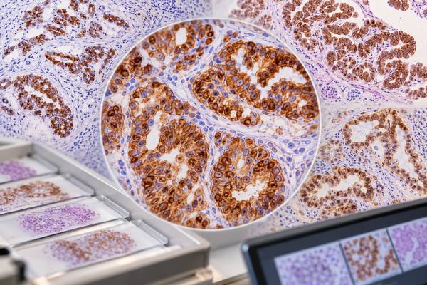 Learn what CK7 IHC positivity means, which cancers are often CK7 positive or negative, how CK7/CK20 patterns guide tumor origin, and where pitfalls occur.
