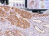 D2-40 IHC Test: Mesothelioma, Lymphatic Tumor Marker, and Positive Staining Understand D2-40 IHC in mesothelioma and lymphatic pathology, including membranous positivity, reactive mesothelial staining, marker panels, BAP1/MTAP, and pitfalls.