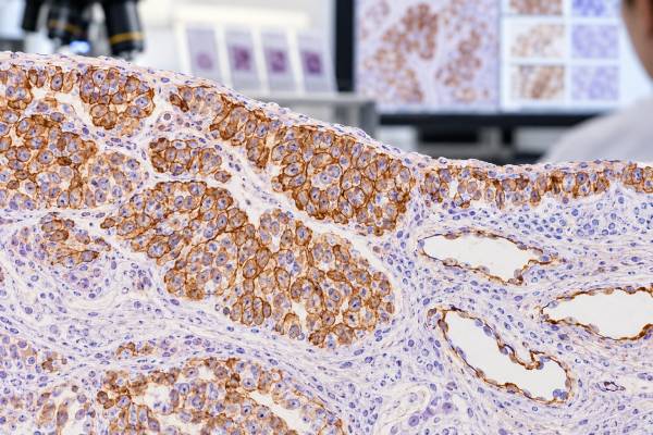 Understand D2-40 IHC in mesothelioma and lymphatic pathology, including membranous positivity, reactive mesothelial staining, marker panels, BAP1/MTAP, and pitfalls.