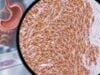 DOG1 IHC Test: Gastrointestinal Stromal Tumor Marker, GIST Diagnosis, and Positive Staining DOG1 IHC helps diagnose gastrointestinal stromal tumors. Learn what positive staining means, how it compares with KIT, and when molecular testing is needed.