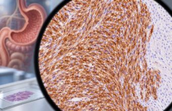 DOG1 IHC Test: Gastrointestinal Stromal Tumor Marker, GIST Diagnosis, and Positive Staining DOG1 IHC helps diagnose gastrointestinal stromal tumors. Learn what positive staining means, how it compares with KIT, and when molecular testing is needed.