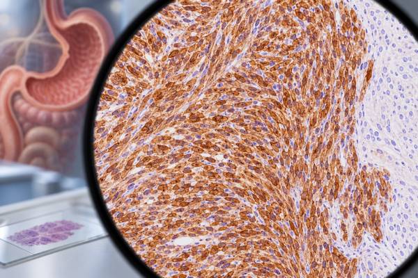 DOG1 IHC helps diagnose gastrointestinal stromal tumors. Learn what positive staining means, how it compares with KIT, and when molecular testing is needed.