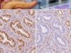 DPC4/SMAD4 IHC helps evaluate pancreatic cancer by showing retained or lost SMAD4 protein. Learn what SMAD4 loss means, how the stain is interpreted, and why other tests are still needed.
