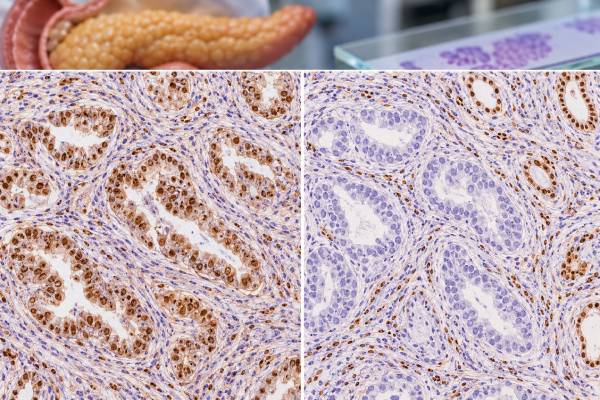 DPC4/SMAD4 IHC helps evaluate pancreatic cancer by showing retained or lost SMAD4 protein. Learn what SMAD4 loss means, how the stain is interpreted, and why other tests are still needed.