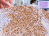 Desmin IHC Test: Muscle Tumor Marker, Sarcoma Classification, and Positive Staining Learn how desmin IHC staining helps identify muscle differentiation, classify smooth-muscle and skeletal-muscle tumors, and guide sarcoma diagnosis.