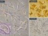 Drug Crystals in Urine: Medication Crystals, Kidney Risk, and Microscopy Findings Drug crystals in urine may reflect medication crystalluria or crystal-related kidney injury. Learn causes, microscopy patterns, kidney risks, and follow-up steps.