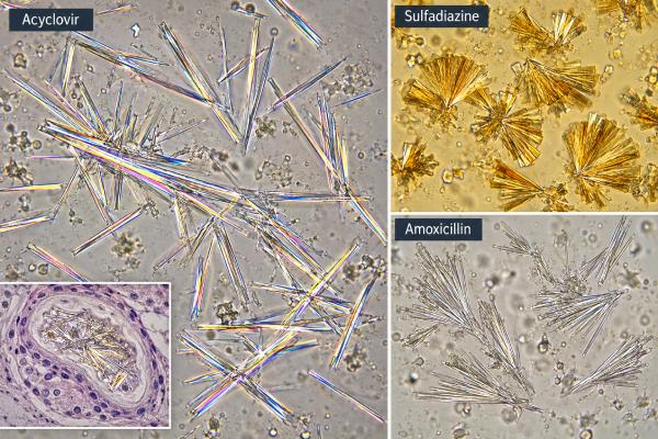 Drug Crystals in Urine: Medication Crystals, Kidney Risk, and Microscopy Findings Drug crystals in urine may reflect medication crystalluria or crystal-related kidney injury. Learn causes, microscopy patterns, kidney risks, and follow-up steps.