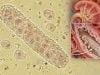 Epithelial Cell Casts in Urine: Kidney Tubule Damage and Acute Tubular Injury Epithelial cell casts in urine can signal kidney tubule damage and acute tubular injury. Learn causes, microscopy patterns, related casts, and follow-up.