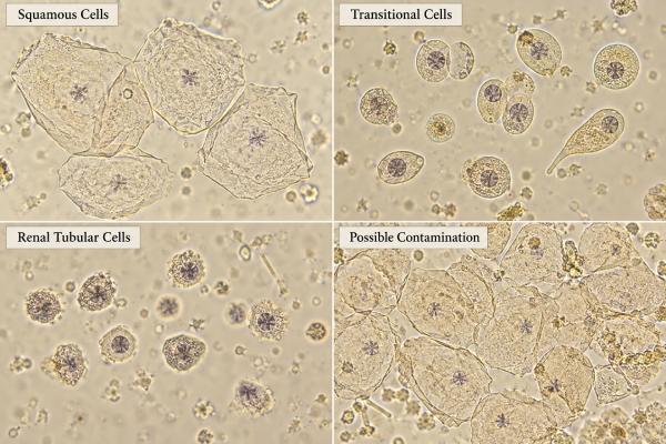 Epithelial Cells in Urine Test: Squamous, Transitional, Renal Cells, and Contamination Epithelial cells in urine may be squamous, transitional, or renal tubular. Learn what high counts mean, how contamination affects results, and when follow-up matters.