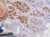 Estrogen receptor IHC measures ER protein in breast cancer. Learn the 1% positive cutoff, what ER Low Positive at 1%–10% means, how results are scored, and how ER status guides hormone therapy.