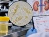 Fatty Casts in Urine: Nephrotic Syndrome, Proteinuria, and Kidney Disease Fatty casts in urine are a sign of lipiduria often linked to nephrotic syndrome and heavy proteinuria. Learn causes, microscopy clues, and follow-up.