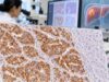 Glypican-3 IHC can support hepatocellular carcinoma diagnosis. Learn what positive GPC3 staining means and how it fits with other liver tumor markers.
