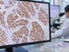 Learn how INSM1 IHC nuclear staining identifies neuroendocrine differentiation, how it compares with synaptophysin and chromogranin, and what positive results mean.