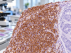 CDX2 IHC Test: Colorectal Cancer Marker, GI Tumor Origin, and Positive Staining Understand CDX2 IHC positivity in colorectal and GI cancers, including nuclear staining, metastatic tumor-origin panels, CDX2-negative colorectal cancer, and key pitfalls.