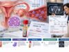 Inhibin A Test for Ovarian Cancer: Granulosa Cell Tumor Marker and Monitoring Learn how inhibin A is used as a granulosa cell tumor marker, what high and normal results can mean, why inhibin B is often more sensitive, and how serial inhibin A levels can support long-term ovarian cancer monitoring.