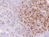 The Ki-67 IHC test measures tumor-cell proliferation. Learn what a high Ki-67 score means, how the index is counted, tumor-specific cutoffs, prognosis, and key limitations.