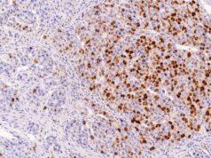 The Ki-67 IHC test measures tumor-cell proliferation. Learn what a high Ki-67 score means, how the index is counted, tumor-specific cutoffs, prognosis, and key limitations.