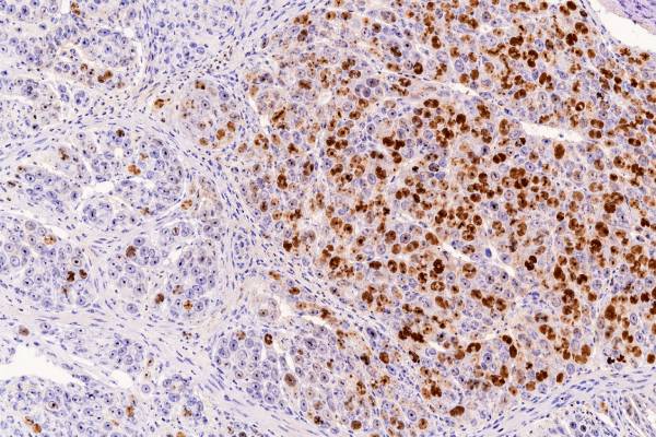 The Ki-67 IHC test measures tumor-cell proliferation. Learn what a high Ki-67 score means, how the index is counted, tumor-specific cutoffs, prognosis, and key limitations.