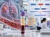 MET Exon 14 Skipping Test for Lung Cancer: Splice Alteration, Mutation Status, and Meaning Learn what MET exon 14 skipping means in lung cancer, how DNA and RNA tests detect it, how positive and negative results are interpreted, and why METex14 can guide targeted NSCLC treatment.