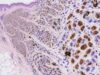 The MITF IHC test is a nuclear melanocytic marker used in melanoma diagnosis. Learn what positive staining means, how MITF compares with SOX10 and Melan-A, and its key limitations.