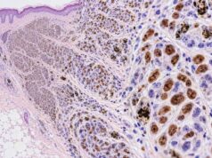 The MITF IHC test is a nuclear melanocytic marker used in melanoma diagnosis. Learn what positive staining means, how MITF compares with SOX10 and Melan-A, and its key limitations.