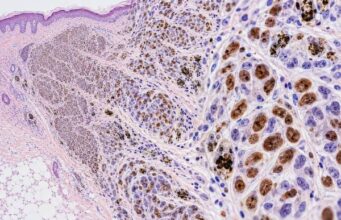 The MITF IHC test is a nuclear melanocytic marker used in melanoma diagnosis. Learn what positive staining means, how MITF compares with SOX10 and Melan-A, and its key limitations.