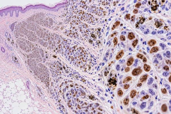 MITF IHC Test Melanoma Marker, Melanocytic Tumor Diagnosis, and Positive Staining The MITF IHC test is a nuclear melanocytic marker used in melanoma diagnosis. Learn what positive staining means, how MITF compares with SOX10 and Melan-A, and its key limitations.