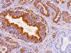 The MUC1 IHC test detects a widely expressed epithelial mucin. Learn what positive staining means, normal versus tumor patterns, common carcinomas that express MUC1, and major limitations.