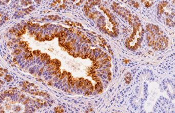 The MUC1 IHC test detects a widely expressed epithelial mucin. Learn what positive staining means, normal versus tumor patterns, common carcinomas that express MUC1, and major limitations.