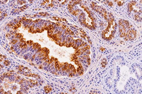MUC1 IHC Test Carcinoma Marker, Tumor Expression, and Staining Pattern The MUC1 IHC test detects a widely expressed epithelial mucin. Learn what positive staining means, normal versus tumor patterns, common carcinomas that express MUC1, and major limitations.