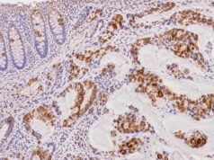 The MUC2 IHC test detects intestinal goblet-cell mucin. Learn what positive staining means in colorectal, appendiceal, pancreatic, and mucinous tumors and how MUC2 fits into IHC panels.